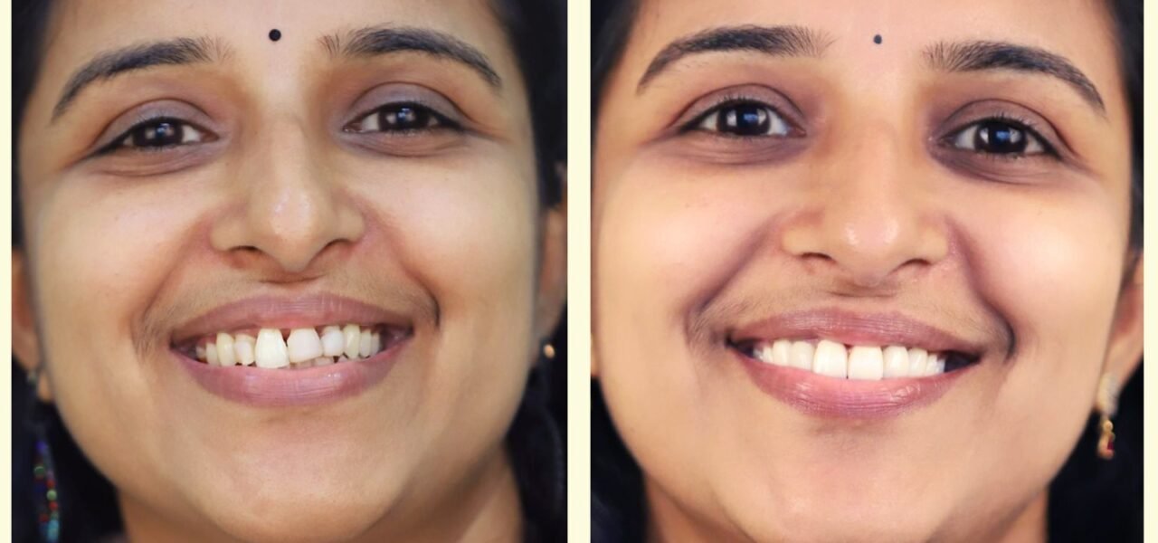 before-after-smile design-makeover