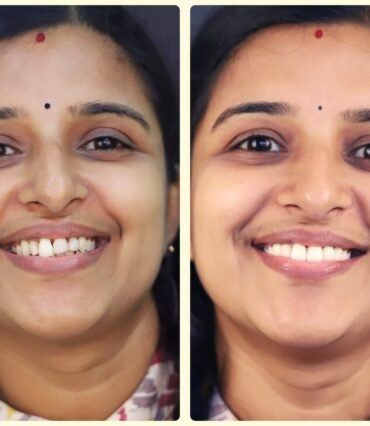 before-after-smile design-makeover
