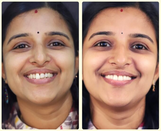 before-after-smile design-makeover