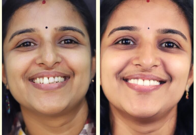 before-after-smile design-makeover