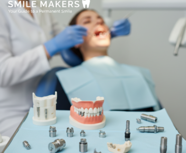 Dental implants imagic dental clinic palakkad