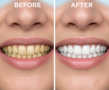 Teeth Whitening