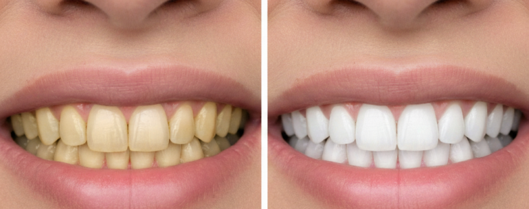Teeth Whitening